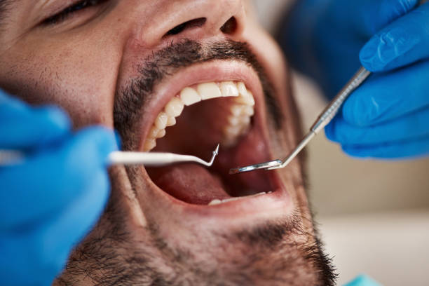 Best Emergency Dental Extractions in South Lebanon, OH